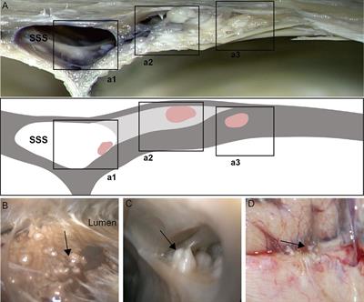 Anatomical Study of Arachnoid Granulation in Superior Sagittal Sinus Correlated to Growth Patterns of Meningiomas